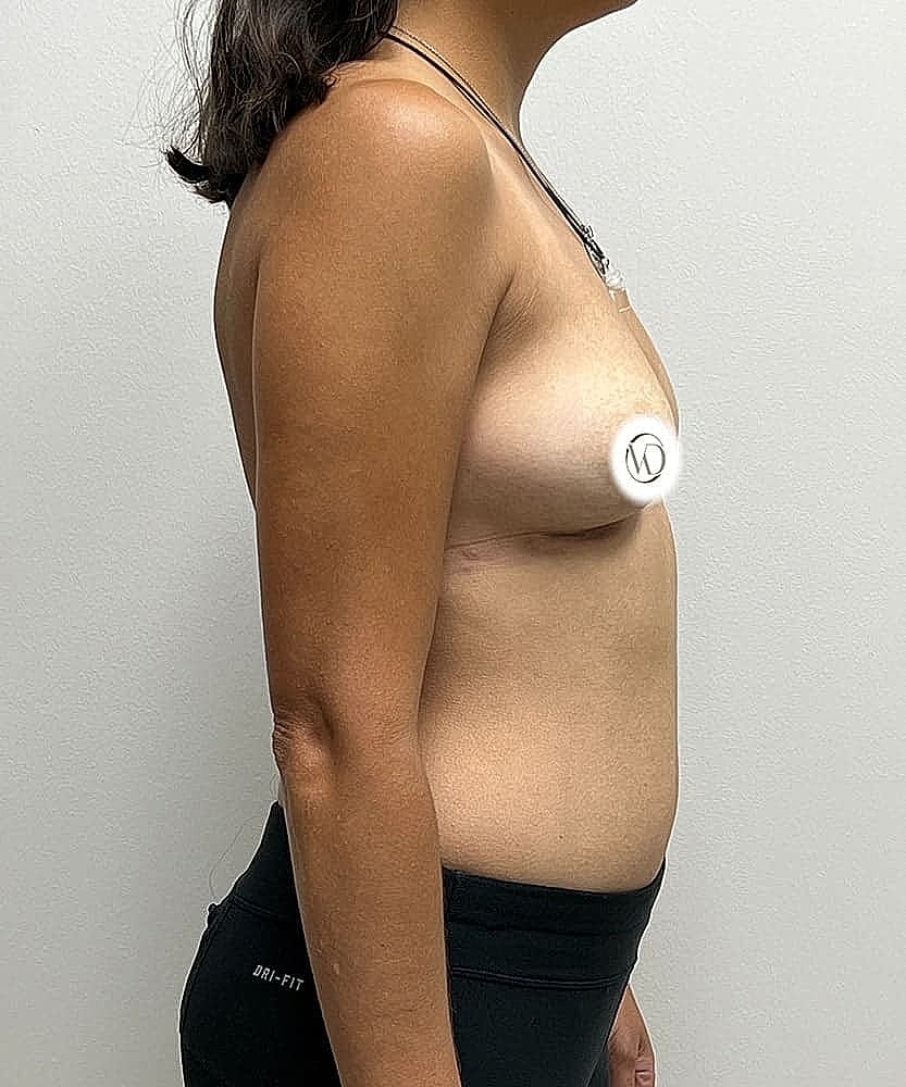 Breast Implant Removal (Explant) Gallery Before & After