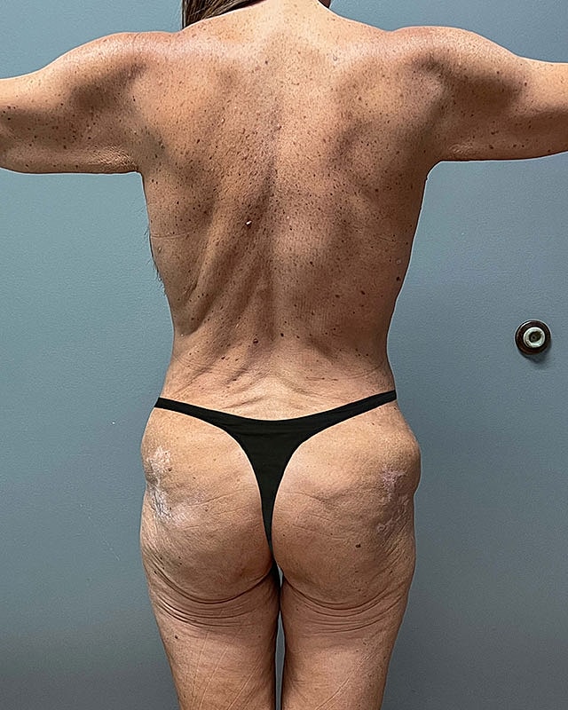 Posterior Body Lift Before & After