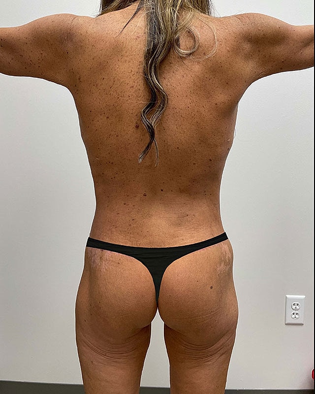 Posterior Body Lift Before & After