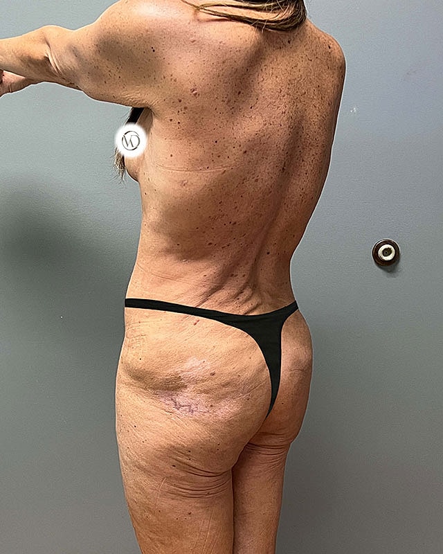 Posterior Body Lift Before & After