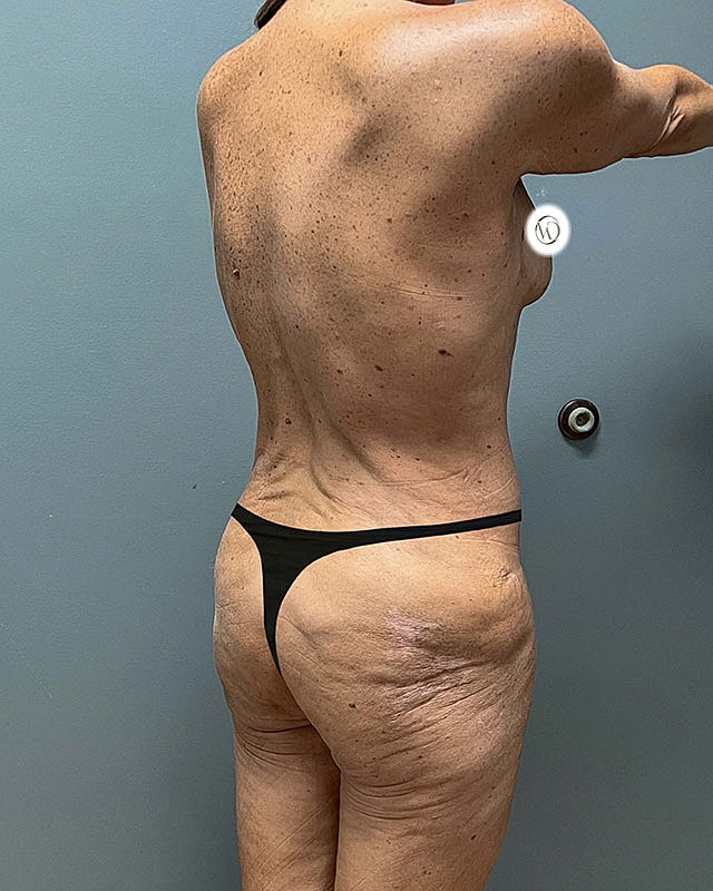 Posterior Body Lift Before & After