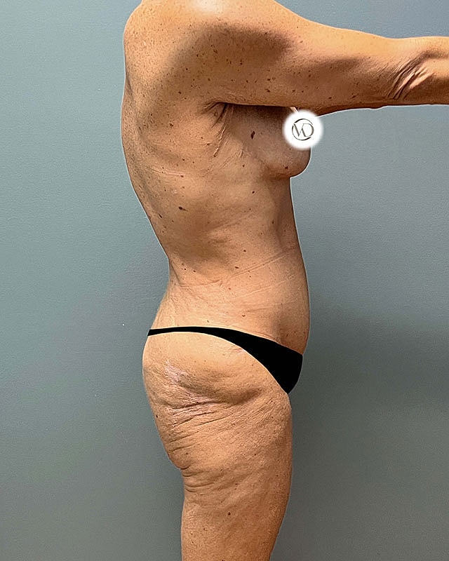 Posterior Body Lift Before & After