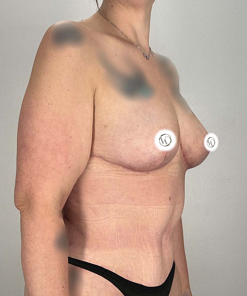 Breast Lift With Fat Grafting Before & After