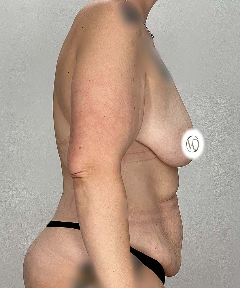 Breast Lift With Fat Grafting Before & After