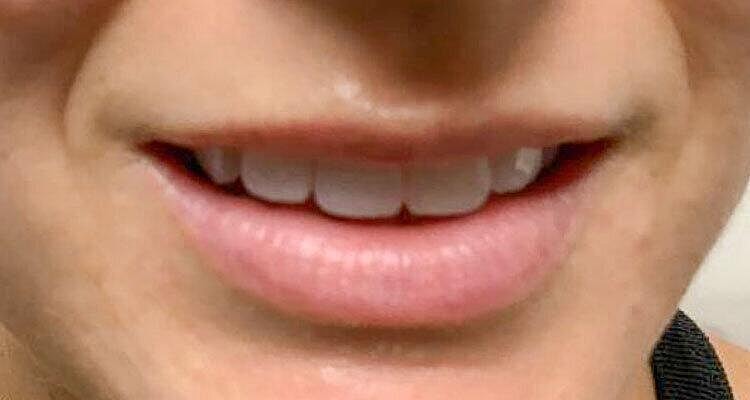 Restylane Before & After