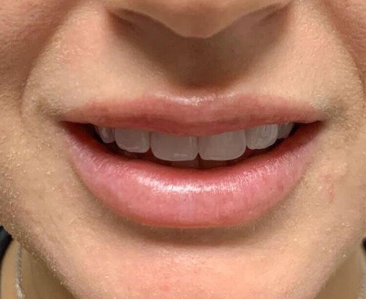 Restylane Before & After