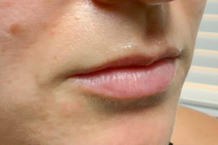 Restylane Before & After