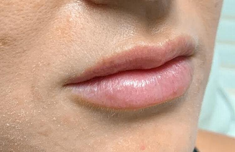 Restylane Before & After