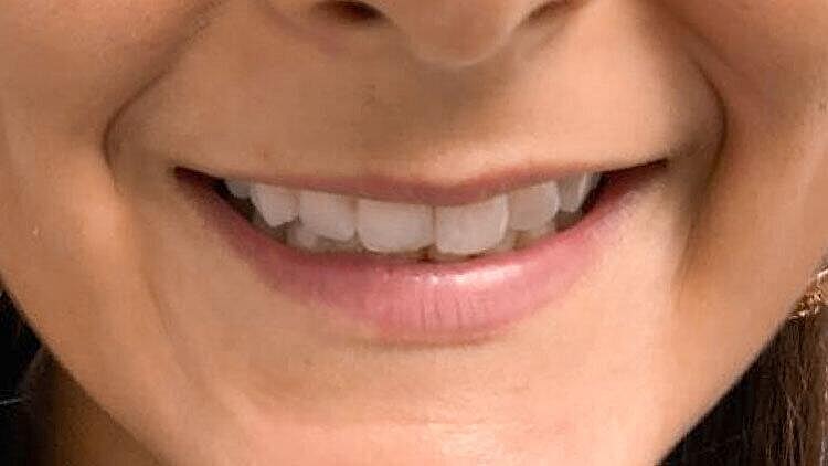 Restylane Before & After