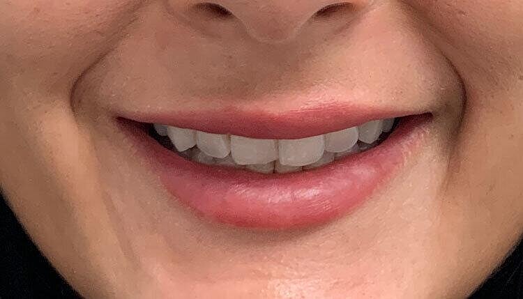 Restylane Before & After