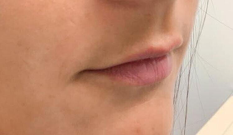 Restylane Before & After