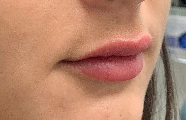 Restylane Before & After