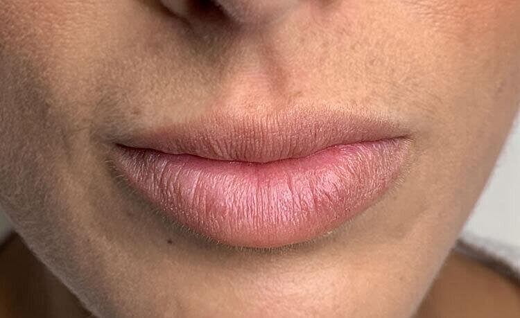 Restylane Before & After