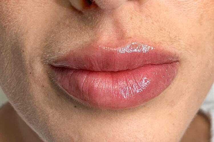 Restylane Before & After