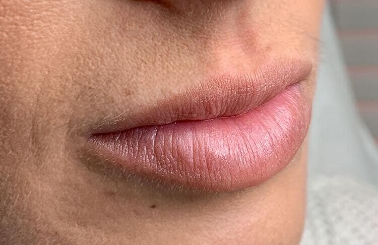 Restylane Before & After