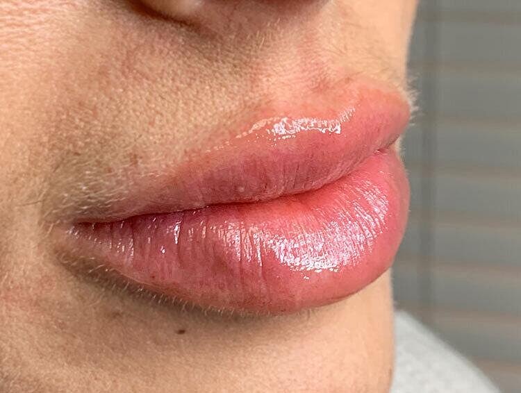 Restylane Before & After