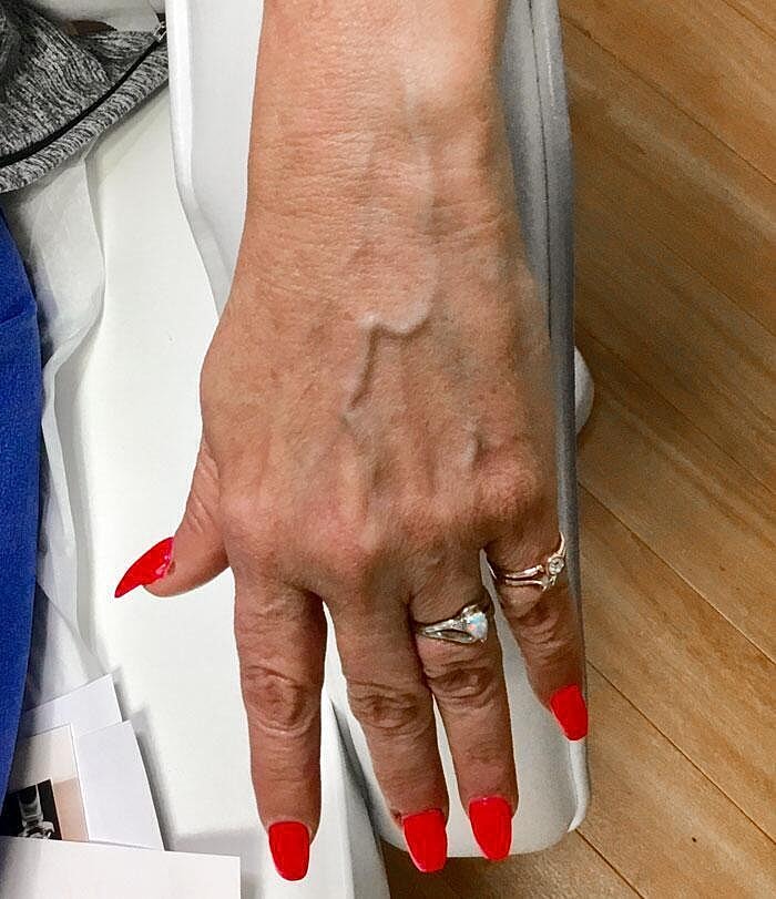 Restylane Before & After
