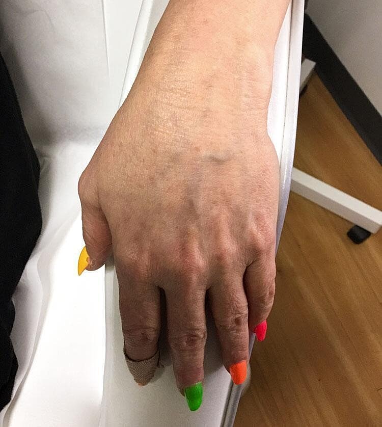 Restylane Before & After