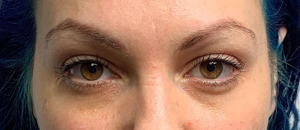 Restylane Before & After