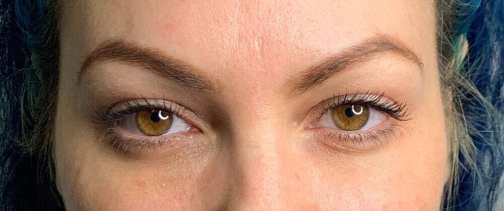 Restylane Before & After