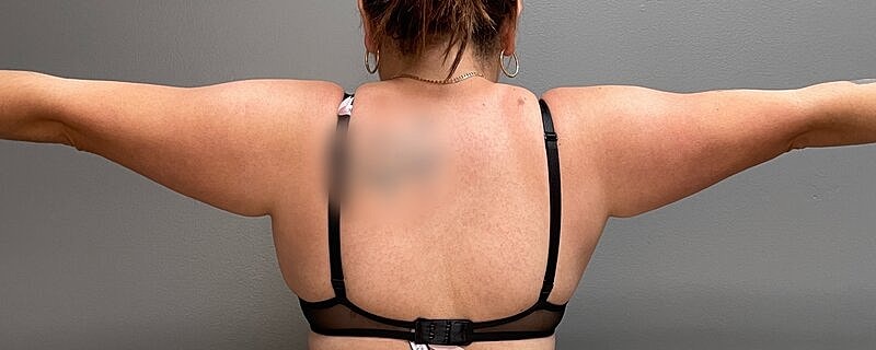 Liposuction Before & After