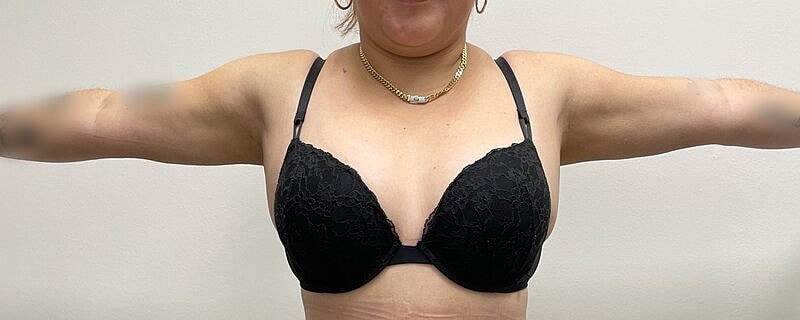 Liposuction Before & After