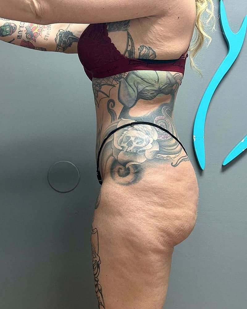 Liposuction Before & After