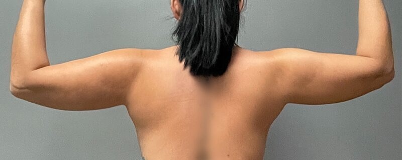 Liposuction Before & After