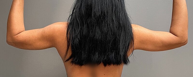 Liposuction Before & After