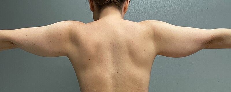 Liposuction Before & After