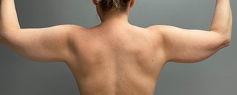 Liposuction Before & After