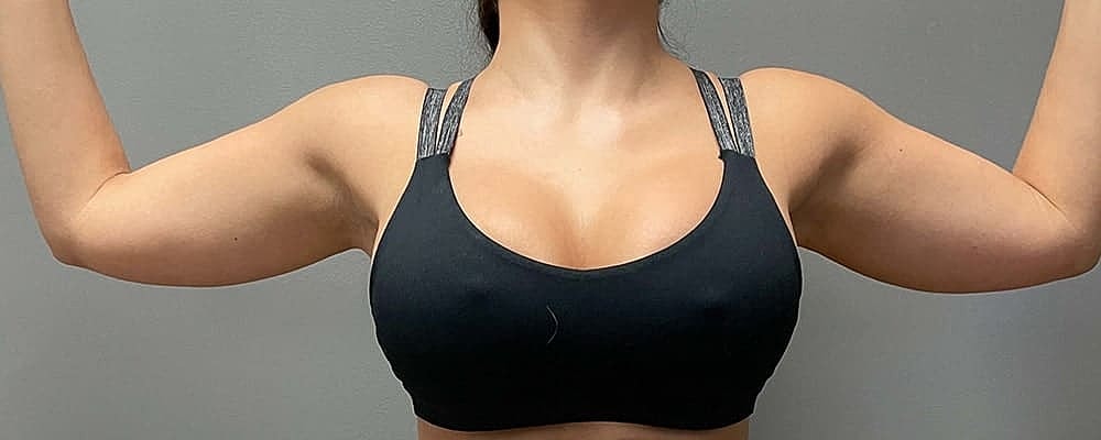 Liposuction Before & After