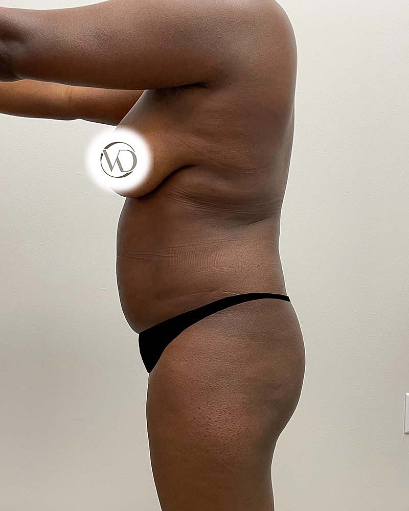 Liposuction Before & After