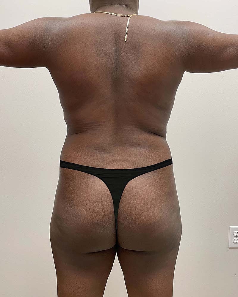Liposuction Before & After