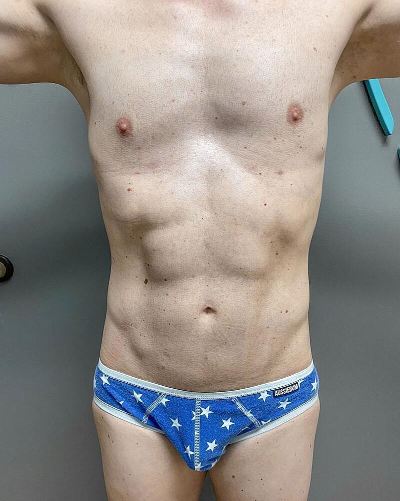 Liposuction Before & After