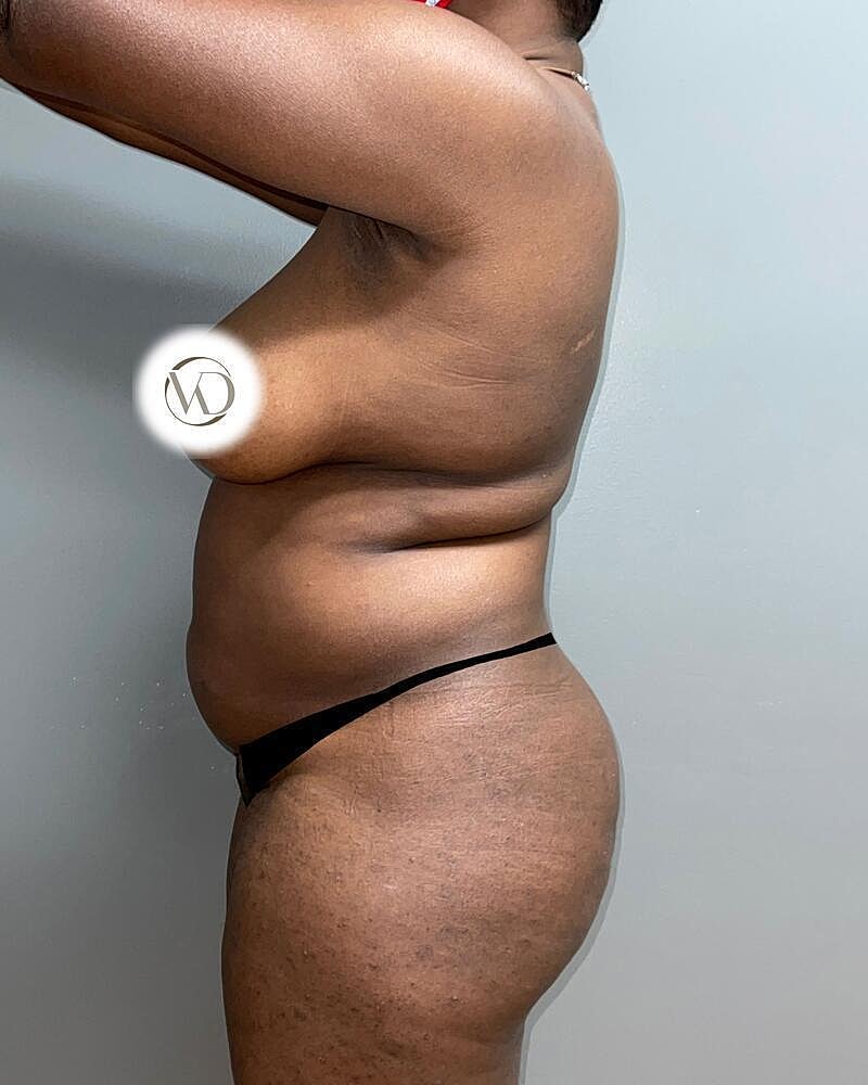 Liposuction Before & After