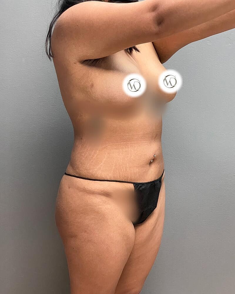 Liposuction Before & After
