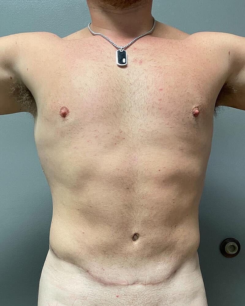 Liposuction Before & After