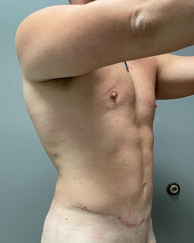 Liposuction Before & After