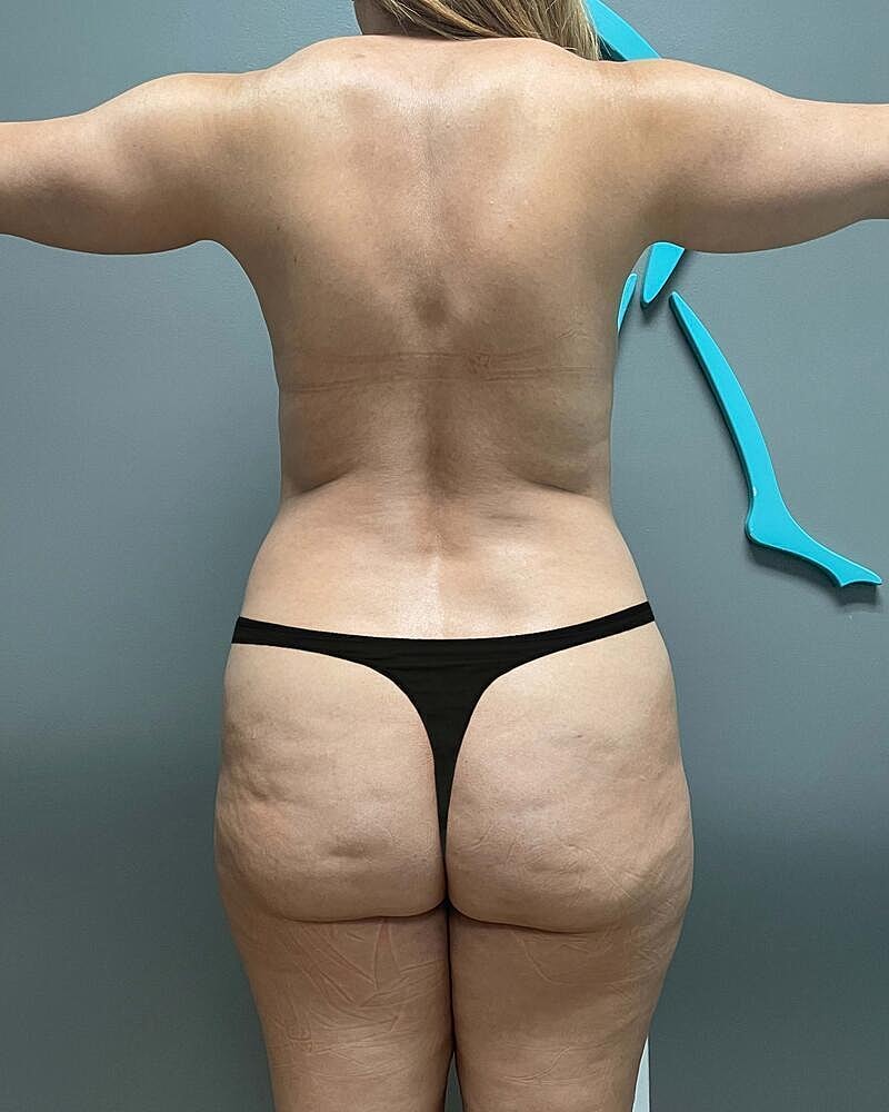 Liposuction Before & After