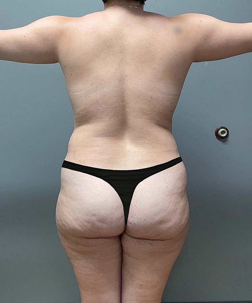 Liposuction Before & After
