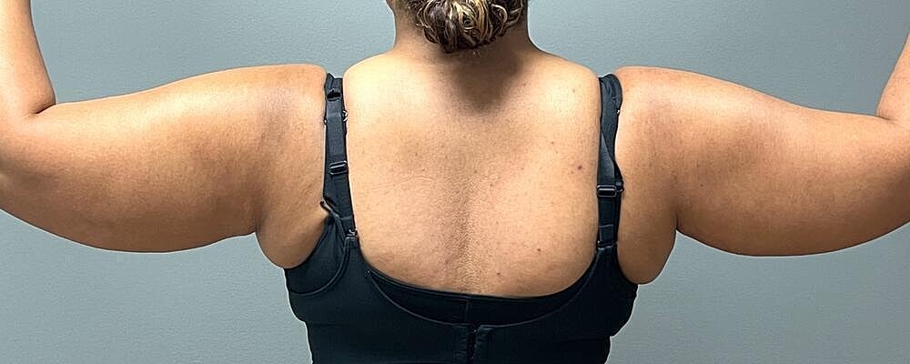 Liposuction Before & After