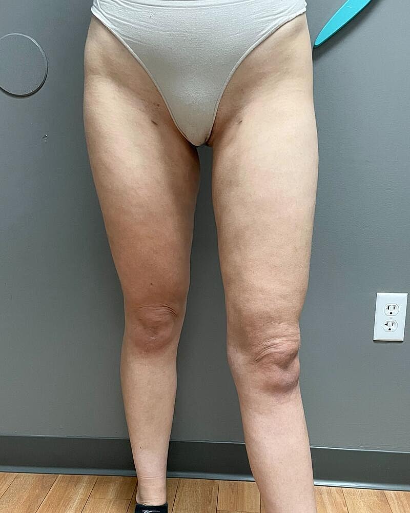 Liposuction Before & After