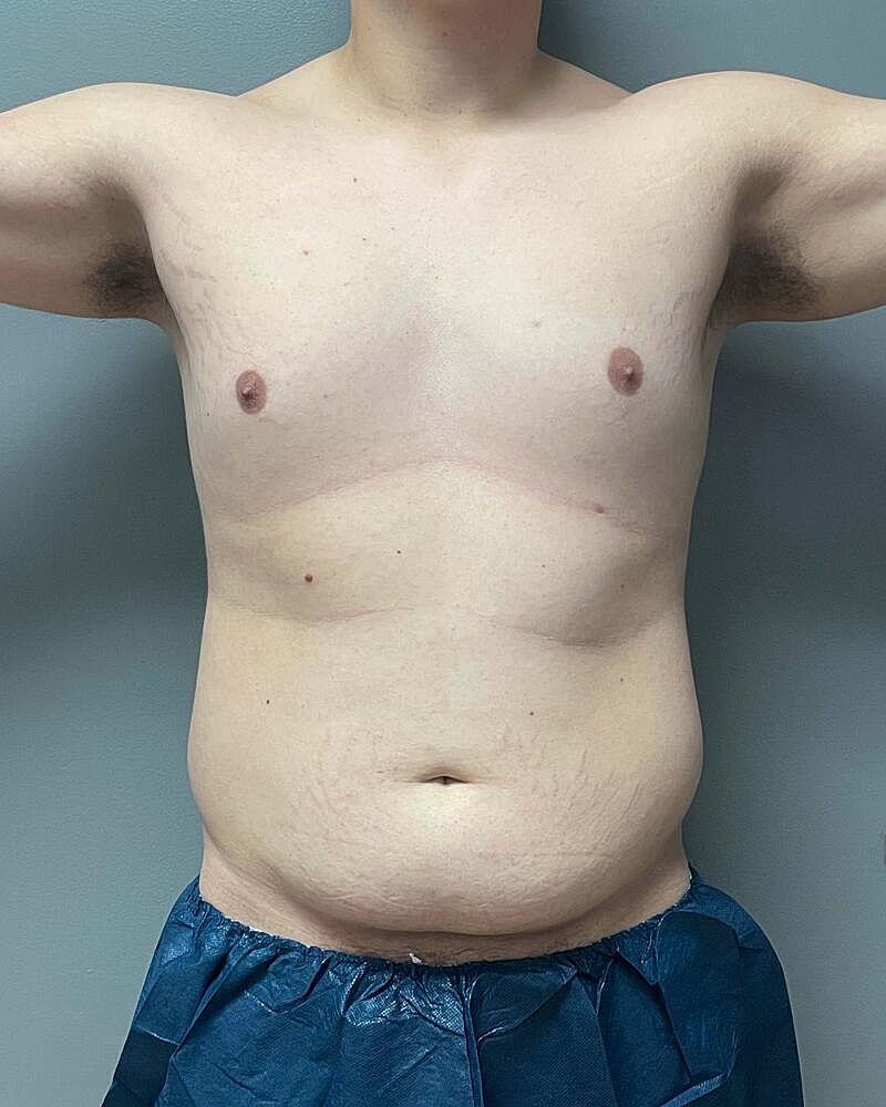 Liposuction Before & After