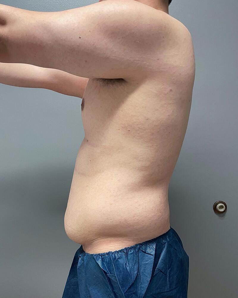 Liposuction Before & After