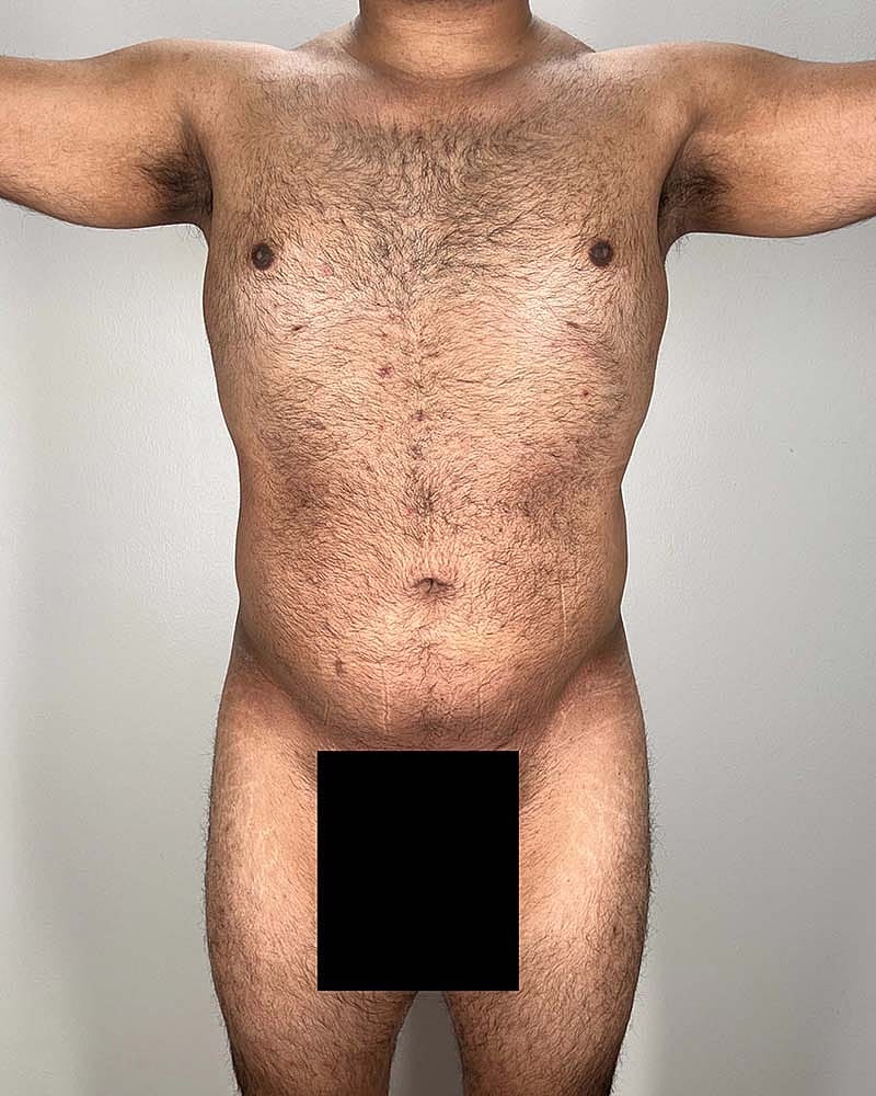 Liposuction Before & After