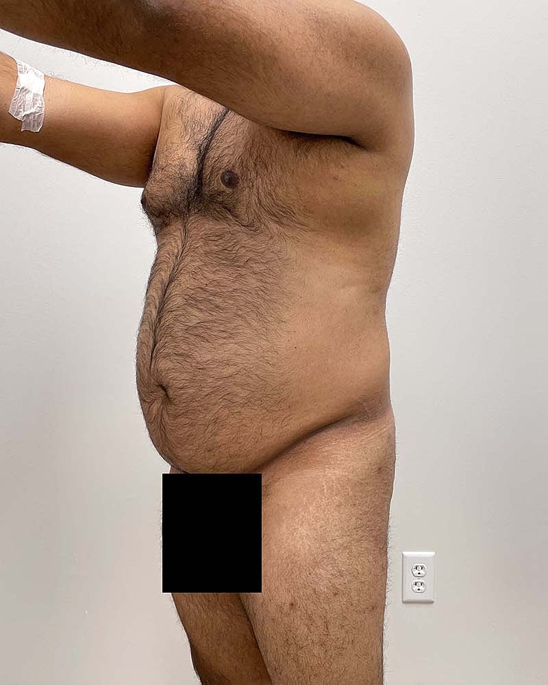 Liposuction Before & After