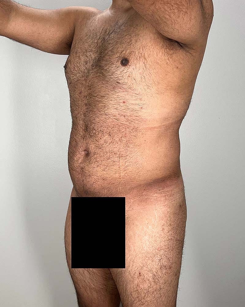 Liposuction Before & After