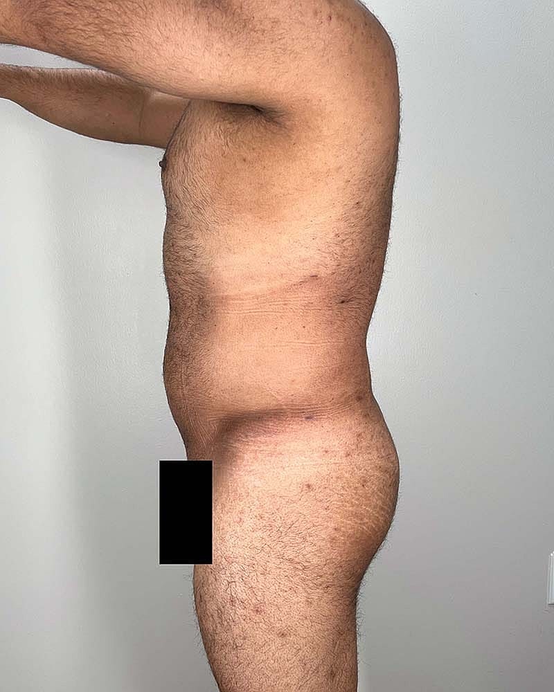 Liposuction Before & After