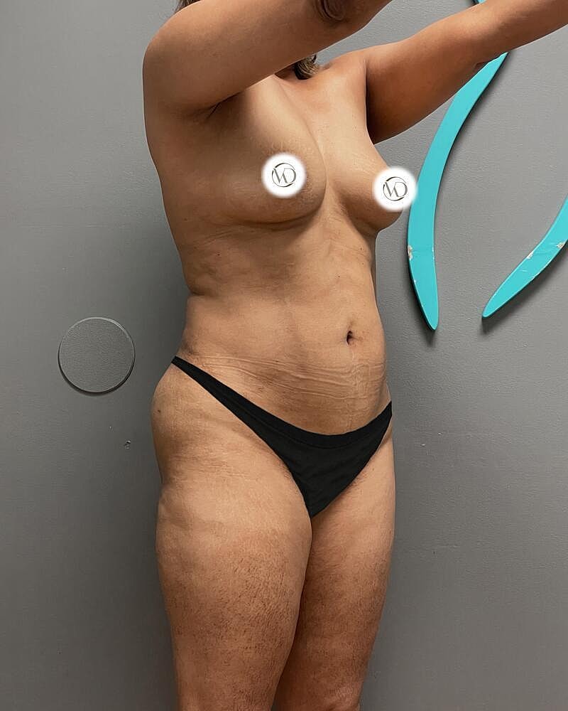 Liposuction Before & After